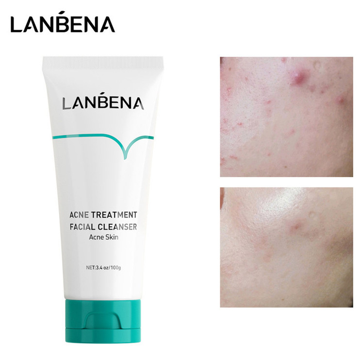 فوم شستوشوی صورت ضدجوش لانبنا مدل Acne Solution وزن ۱۰۰ گرم